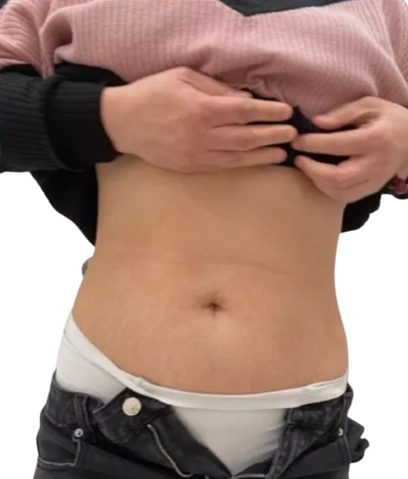 Cellulite Treatment · After · Case 01 · Luowei Medical Aesthetics Clinic