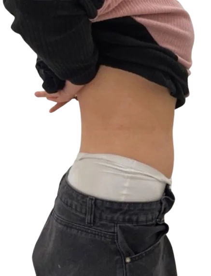 Cellulite Treatment — After · Case 02 · Luowei Medical Aesthetics Clinic