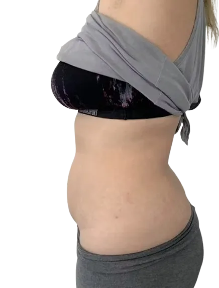 Abdominal Fat — After Treatment · Case 3 · Luowei Medical Aesthetics Clinic