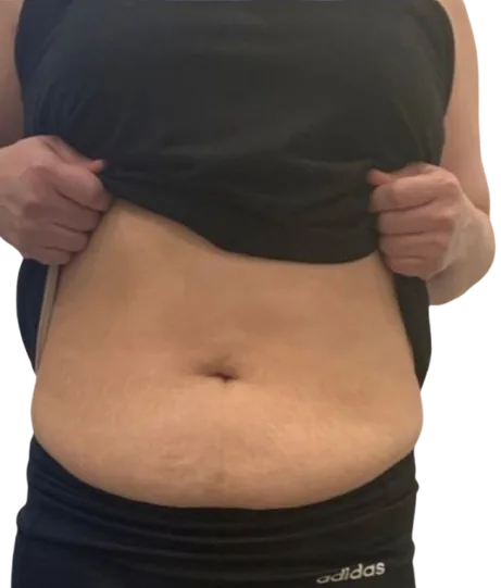 Cellulite Treatment — Before · Case 01 · Luowei Medical Aesthetics Clinic