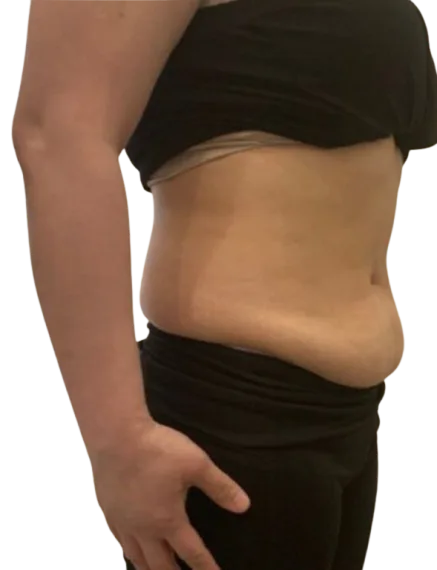 Cellulite — Before Treatment · Case 02 · Luowei Medical Aesthetics Clinic