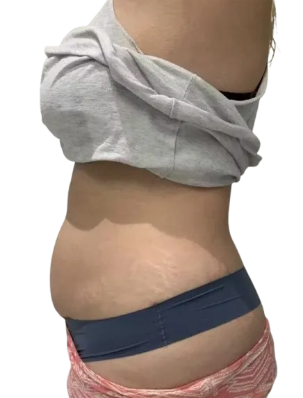 Abdominal Fat — Before · Case 3 · Luowei Medical Aesthetics Clinic