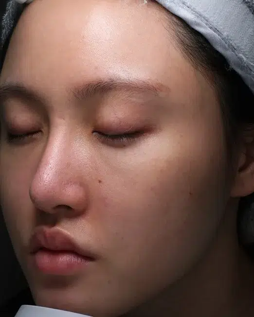 Acne Scar & Skin Texture — After Treatment · Case 01 · Luowei Medical Aesthetics Clinic