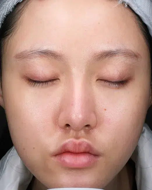 Acne & Breakouts — After Treatment · Case 2 · Luowei Medical Aesthetics Clinic