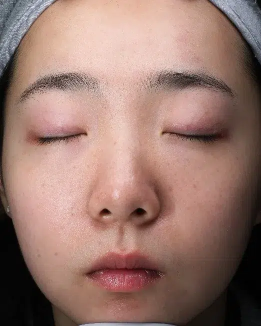 Acne Treatment — After · Case 1 · Luowei Medical Aesthetics Clinic