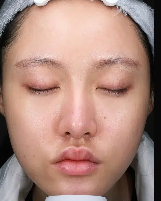 Acne Treatment — After · Case 3 · Luowei Medical Aesthetics Clinic
