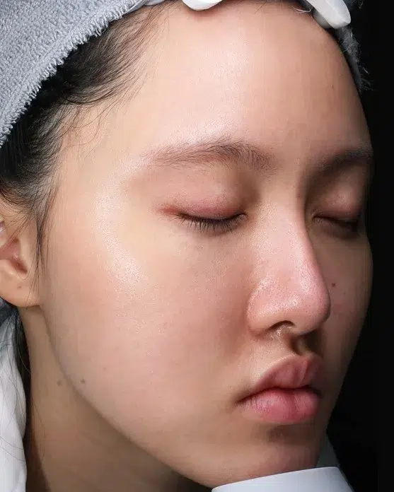 Acne & Blemishes — After · Case 9 · Luowei Medical Aesthetics Clinic