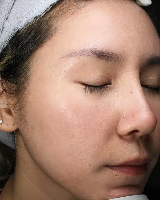 Acne & Breakouts — After · Case 10 · Luowei Medical Aesthetics Clinic