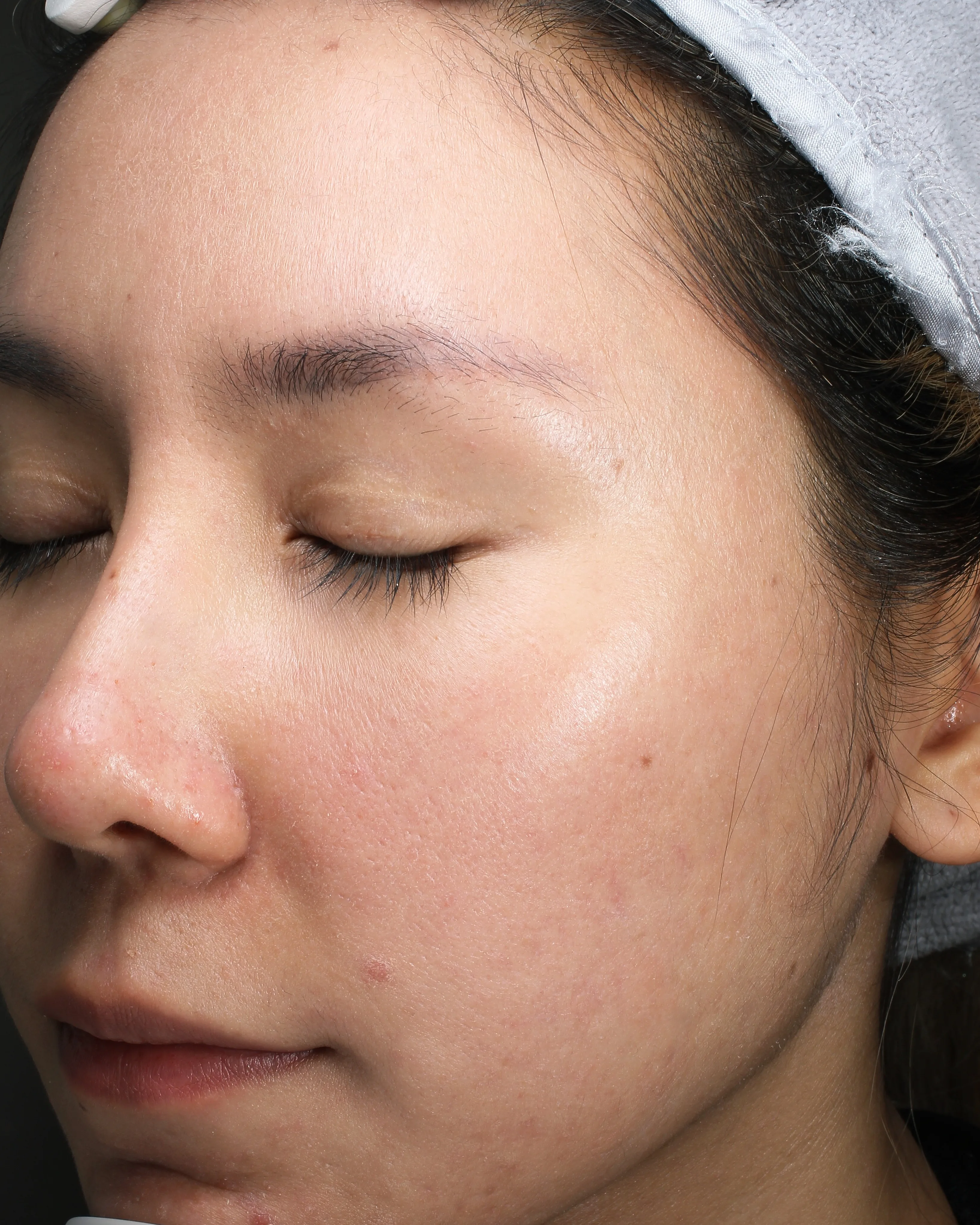 Acne Breakouts After Treatment · Case 12 · Luowei Medical Aesthetics Clinic