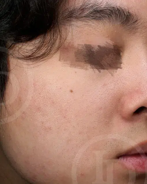 Acne · Breakouts — After · Case 2 · Luowei Medical Aesthetics Clinic