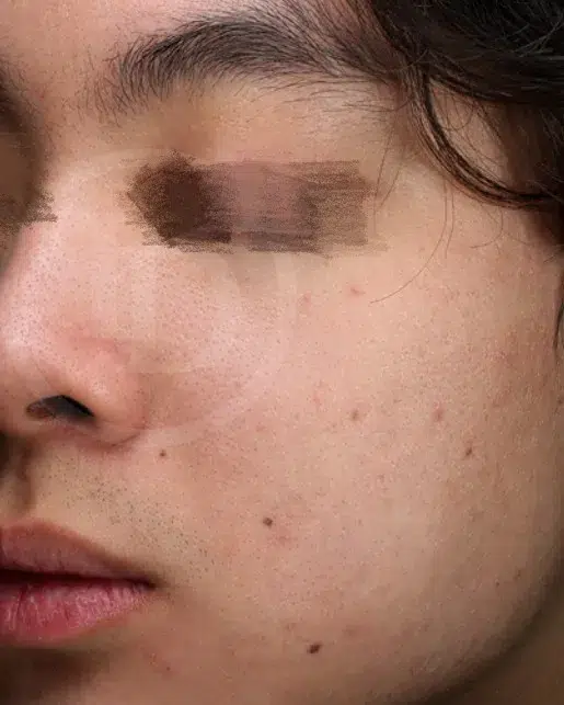 Acne & Breakouts — After · Case 8 · Luowei Medical Aesthetics Clinic