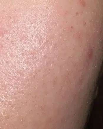 Acne — After · Case 10 · Luowei Medical Aesthetics Clinic