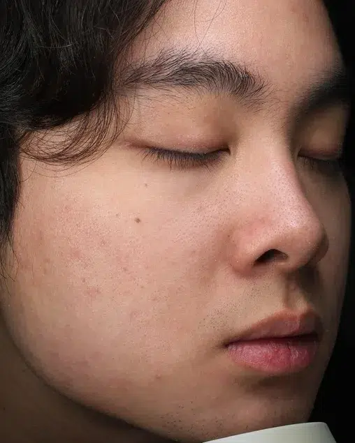 Acne & Breakouts — After · Case 9 · Luowei Medical Aesthetics Clinic