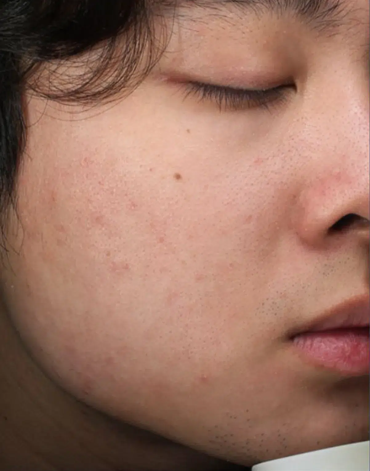 Acne after treatment · Case 7 · Luowei Medical Aesthetics Clinic