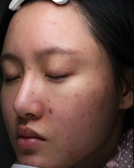 Acne Scars & Skin Texture — Before Treatment · Case 01 · Luowei Medical Aesthetics Clinic