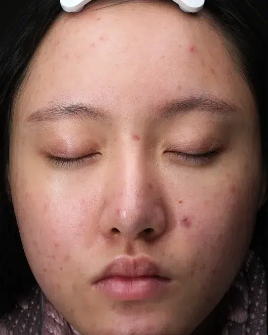 Acne & Breakouts — Before Treatment · Case 2 · Luowei Medical Aesthetics Clinic