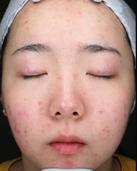 Acne Treatment — Before · Case 1 · Luowei Medical Aesthetics Clinic