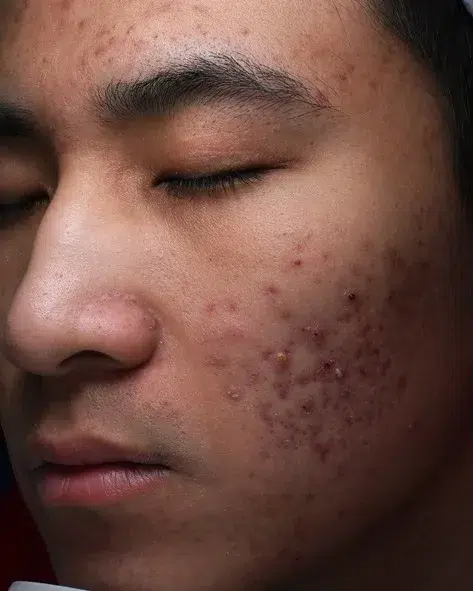 Acne Treatment — Before · Case 2 · Luowei Medical Aesthetics Clinic