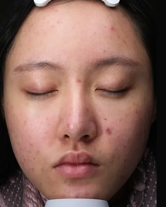 Acne Treatment — Before · Case 3 · Luowei Medical Aesthetics Clinic