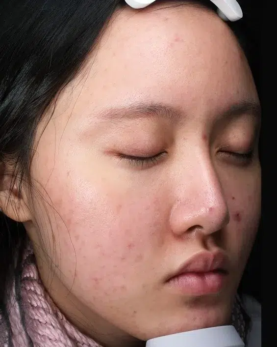 Acne & Blemishes — Before · Case 9 · Luowei Medical Aesthetics Clinic