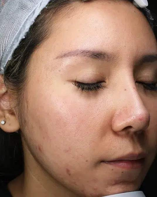 Acne & Breakouts — Before Treatment · Case 10 · Luowei Medical Aesthetics Clinic