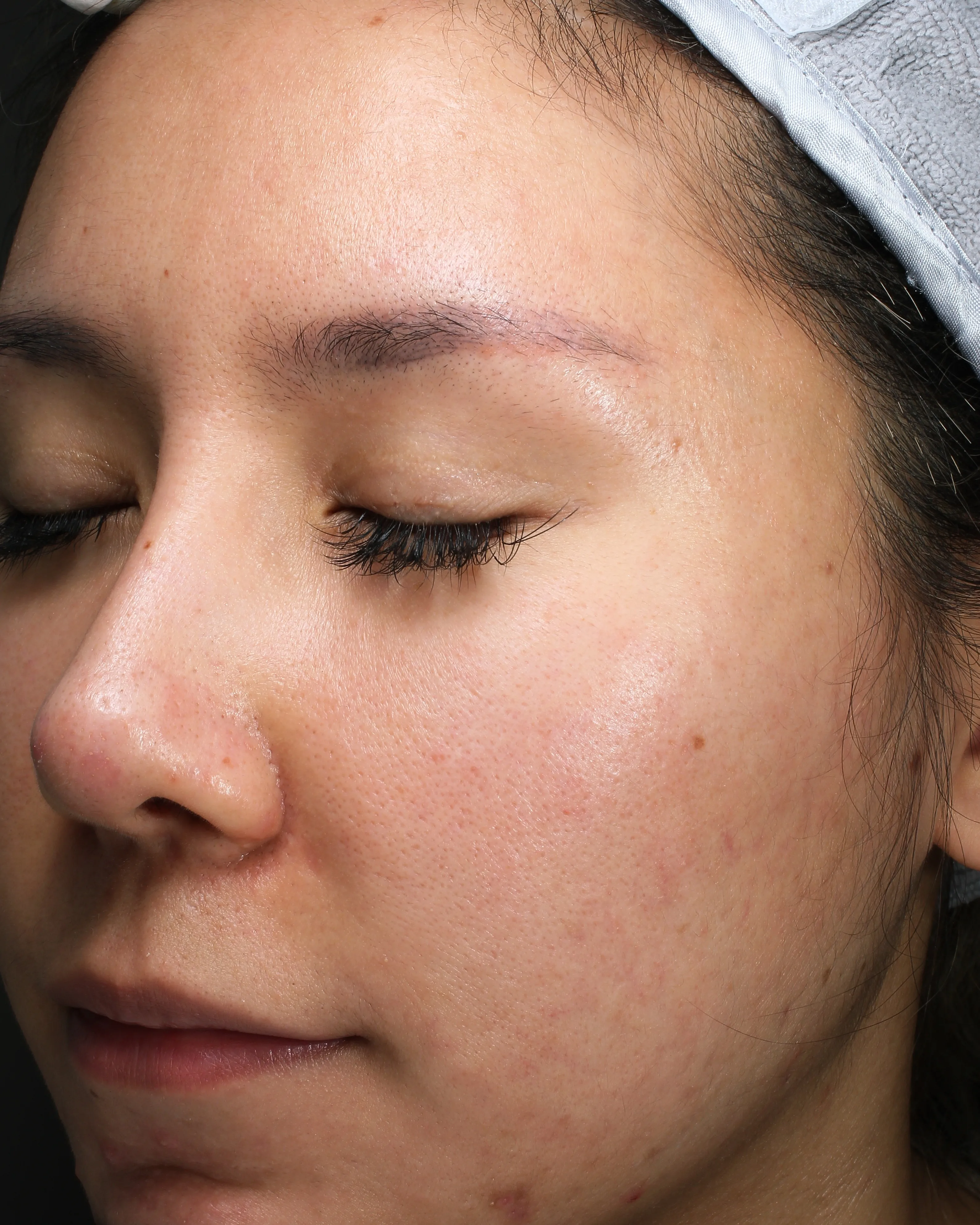 Acne & Breakouts — Before · Case 12 · Luowei Medical Aesthetics Clinic