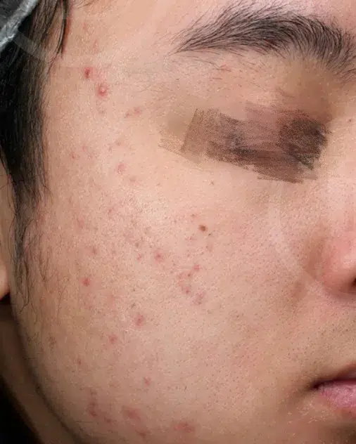 Acne / Breakouts — Before · Case 2 · Luowei Medical Aesthetics Clinic
