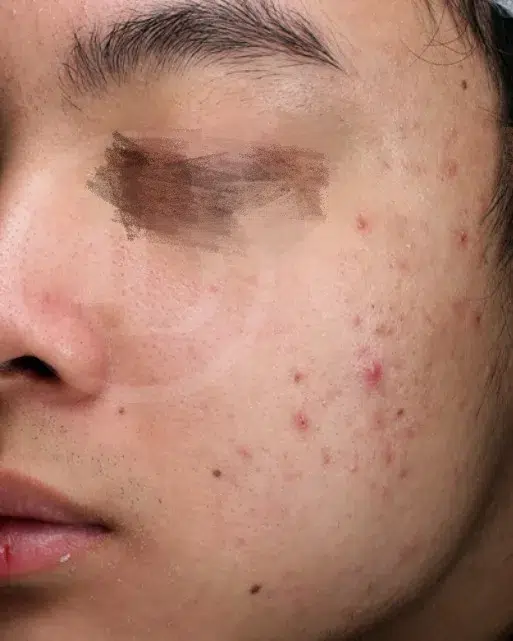 Acne & Breakouts — Before · Case 8 · Luowei Medical Aesthetics Clinic