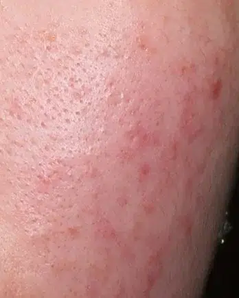 Acne Before Treatment · Case 10 · Luowei Medical Aesthetics Clinic