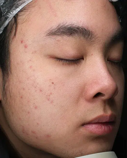 Acne & Breakouts — Before · Case 9 · Luowei Medical Aesthetics Clinic