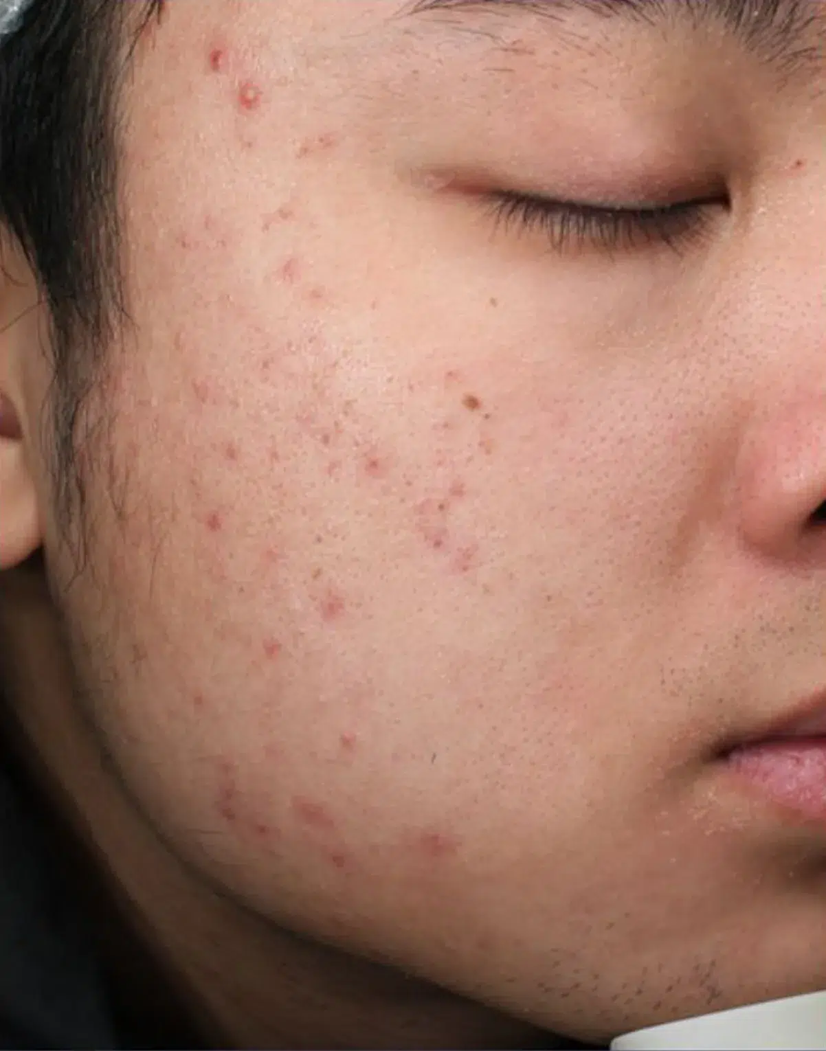 Acne before treatment · Case 7 · Luowei Medical Aesthetics Clinic