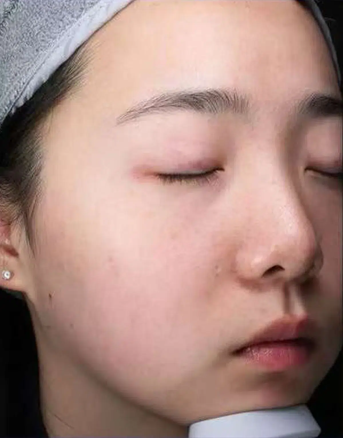 Deep Cleansing & Hydration — Oily, Enlarged Pores, After Treatment · Cleanse & Extract · Luowei Medical Aesthetics Clinic Nanjing · Case 02