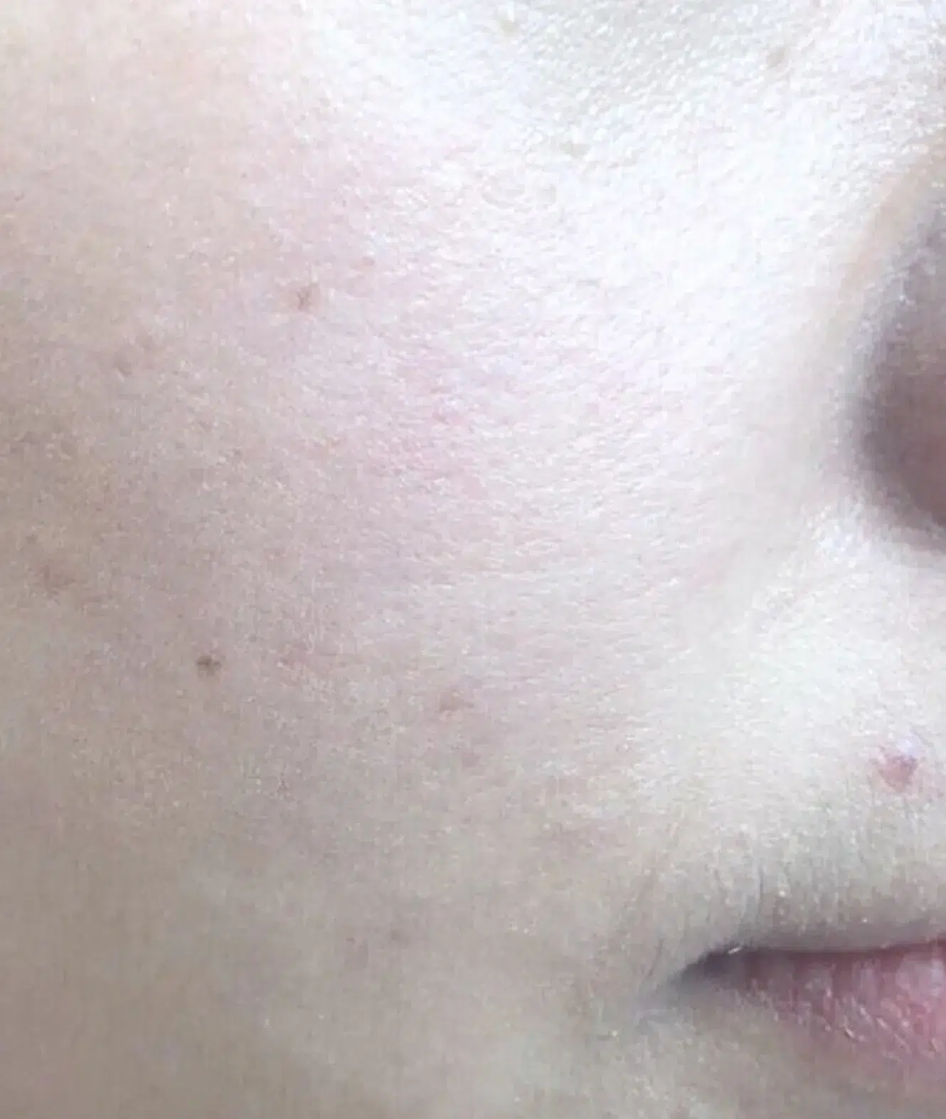 Deep Cleansing & Hydration — Skin Texture Improvement · Before & After · Pre-Event Refresh · Luowei Medical Aesthetics Clinic Nanjing · Case 03