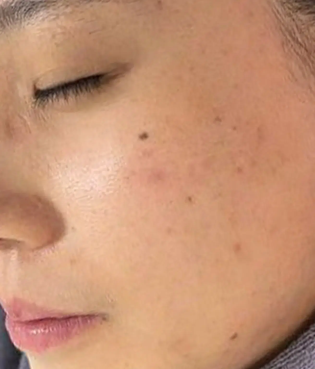 Acne / Comedones / Pimples — After · Case 3 · Luowei Medical Aesthetics Clinic
