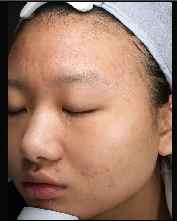 Acne/Comedones/Breakouts — After · Case 14 · Luowei Medical Aesthetics Clinic