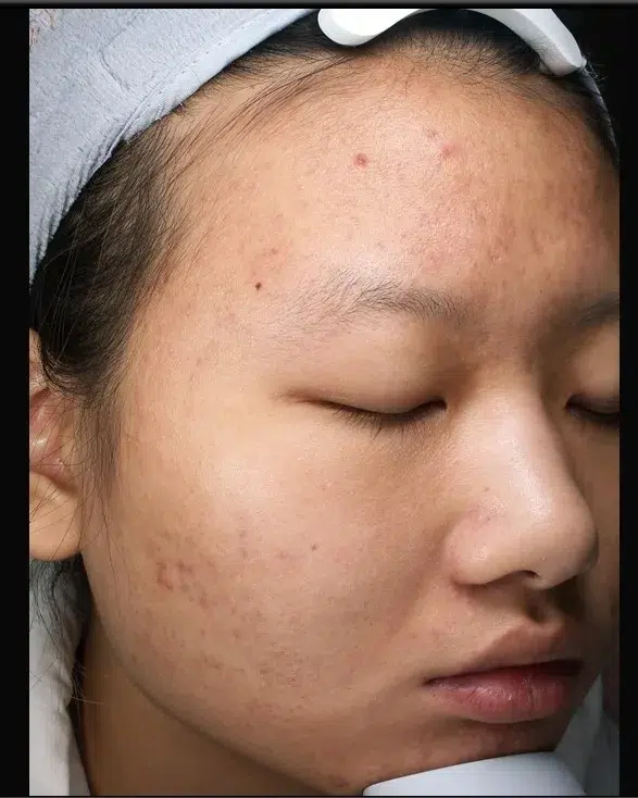 Acne After Treatment · Case 15 · Luowei Medical Aesthetics Clinic