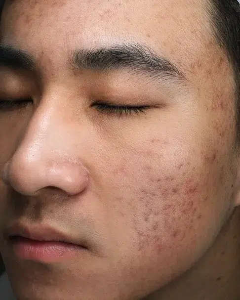 Acne / Comedones / Breakouts — After · Case 6 · Luowei Medical Aesthetics Clinic