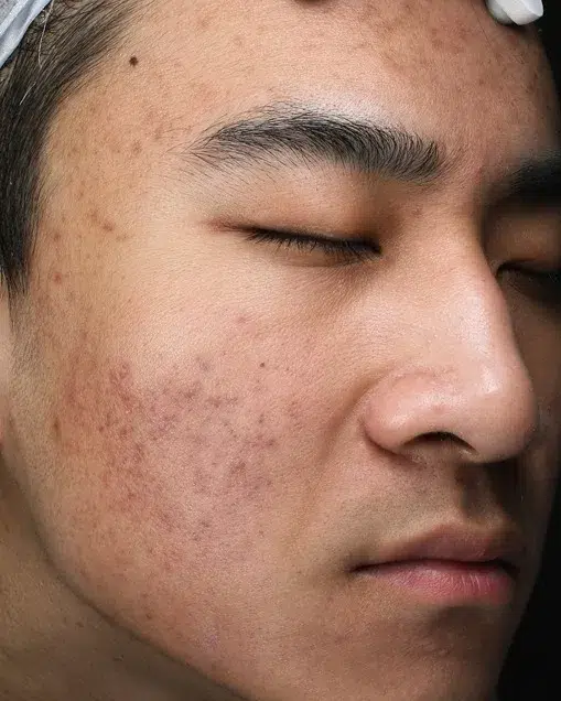 Acne / Comedones / Breakouts — After · Case 7 · Luowei Medical Aesthetics Clinic