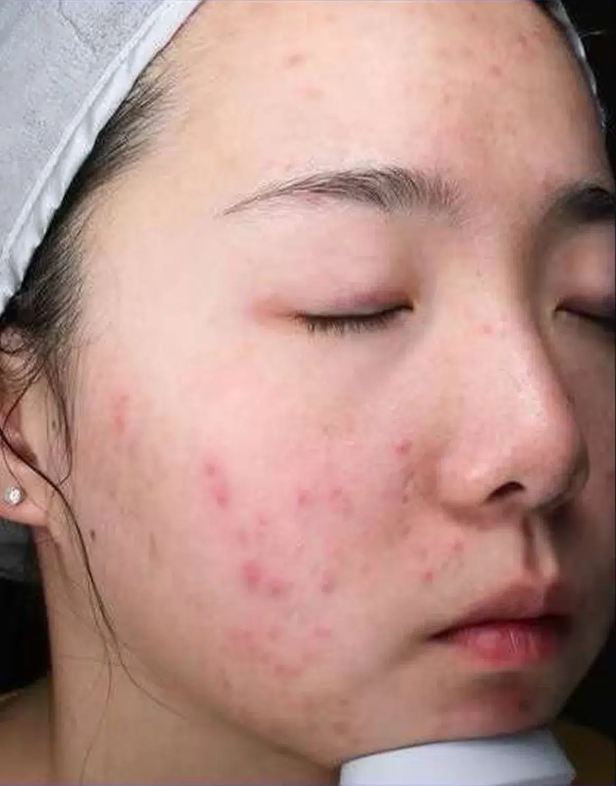 Deep Cleansing & Hydration — Oily Pores Improvement · Before & After · Cleanse & Extraction · Luowei Medical Aesthetics Clinic Nanjing · Case 02