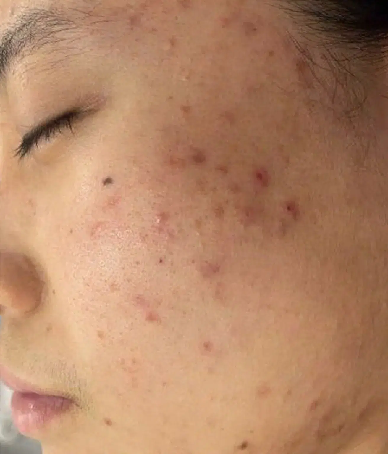 Acne / Comedones / Pimples — Before · Case 3 · Luowei Medical Aesthetics Clinic