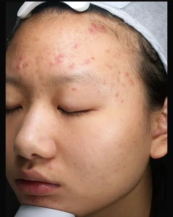 Acne/Comedones/Breakouts — Before · Case 14 · Luowei Medical Aesthetics Clinic