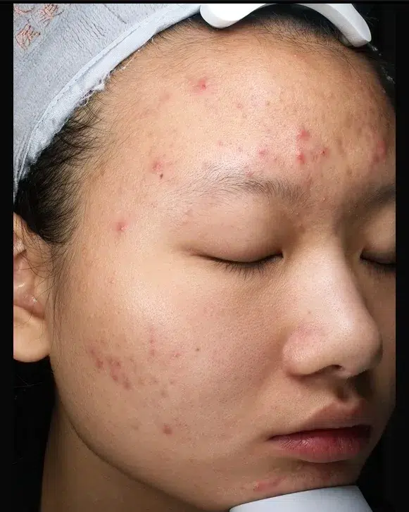 Acne Before Treatment · Case 15 · Luowei Medical Aesthetics Clinic