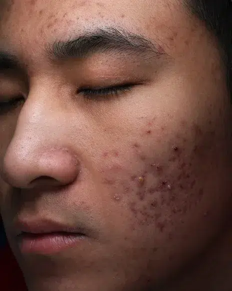 Acne / Comedones / Breakouts — Before · Case 6 · Luowei Medical Aesthetics Clinic