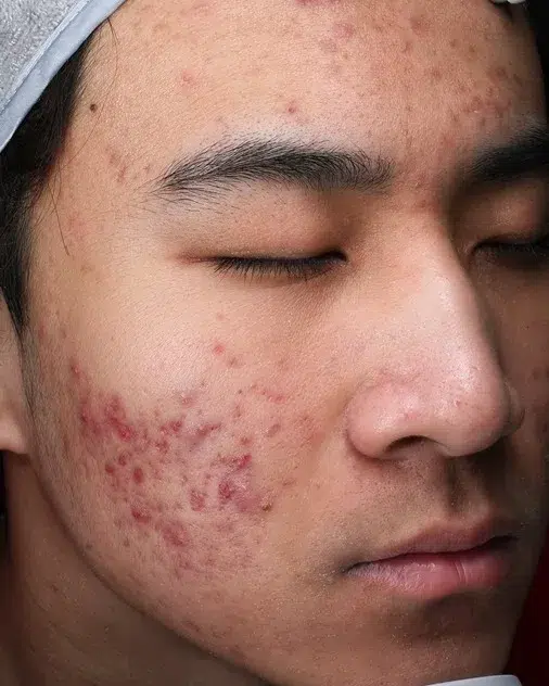 Acne / Comedones / Breakouts — Before · Case 7 · Luowei Medical Aesthetics Clinic