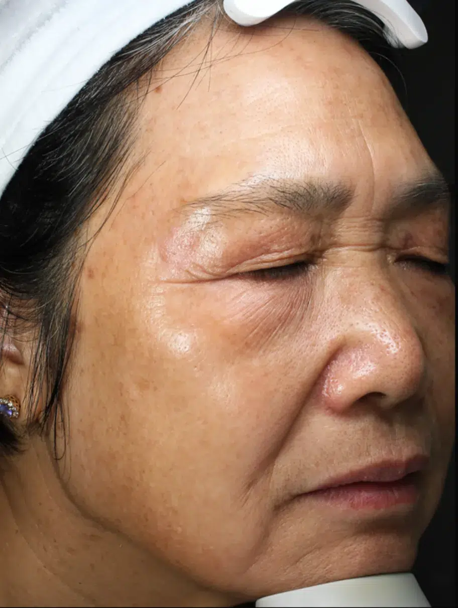 Age Spots / Sun Spots Treatment After · Case 3 · Luowei Medical Aesthetics Clinic