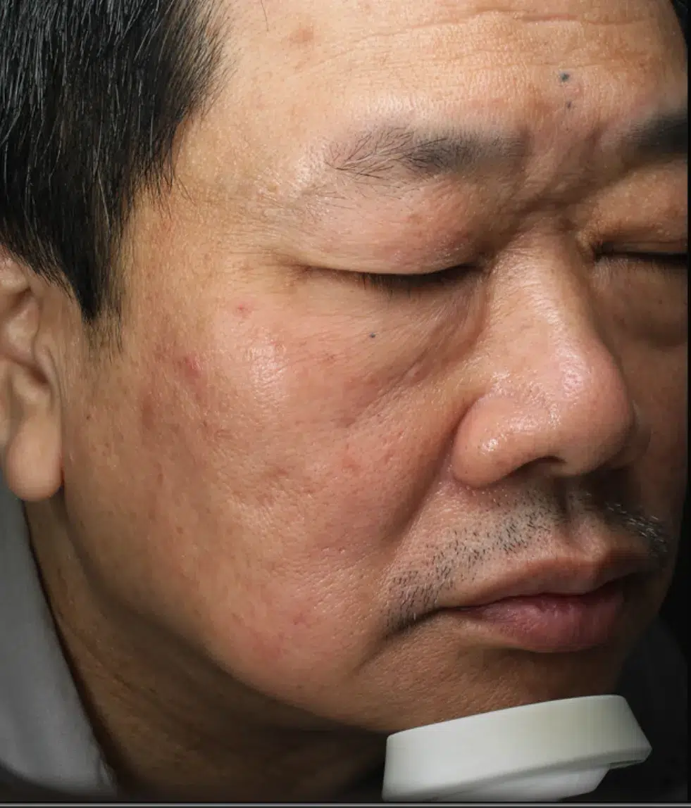 Post-Inflammatory Hyperpigmentation — After Treatment · Case 03 · Luowei Medical Aesthetics Clinic