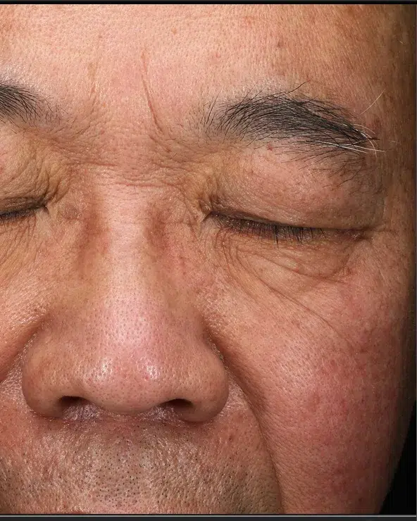 Hyperpigmentation After · Case 38 · Luowei Medical Aesthetics Clinic