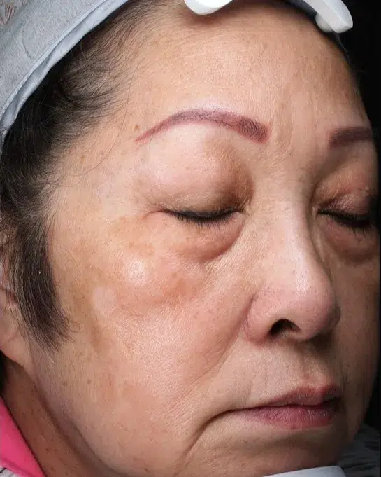 Treating Age Spots / Sun Spots — After · Case 31 · Luowei Medical Aesthetics Clinic