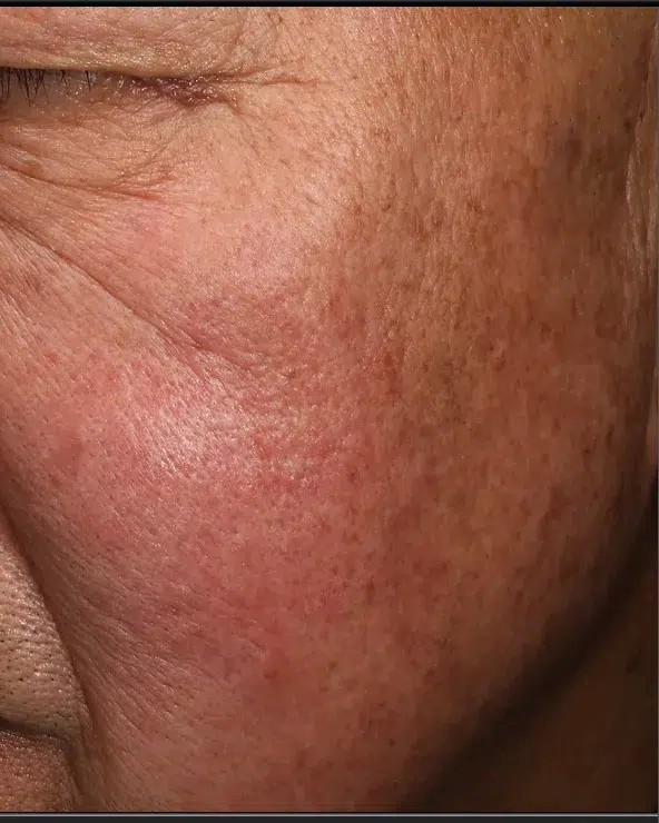 Pigmentation post-treatment · Case 40 · Luowei Medical Aesthetics Clinic