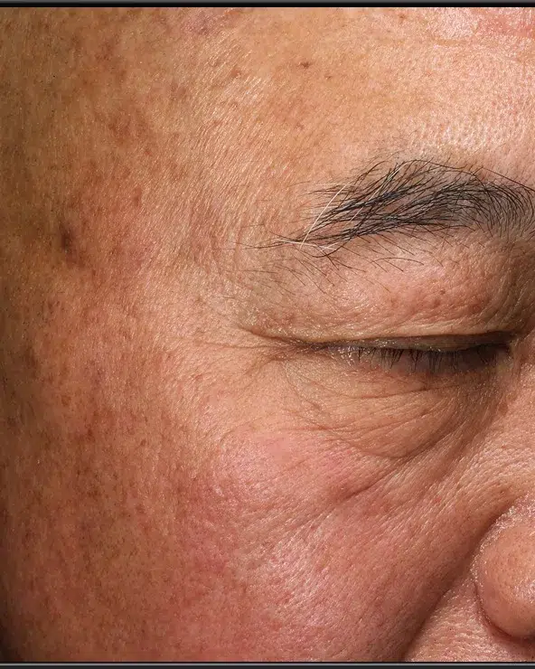 Pigmentation After · Case 41 · Luowei Medical Aesthetics Clinic